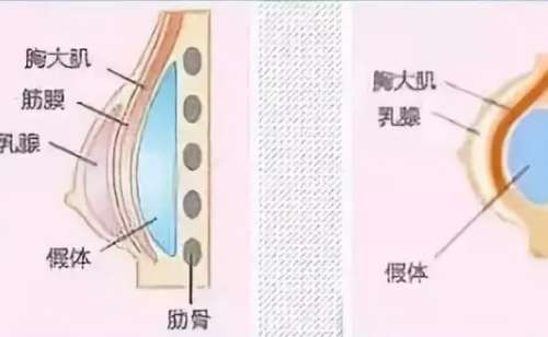 假体隆胸.jpg