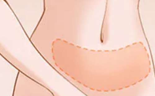 吸脂4.jpg