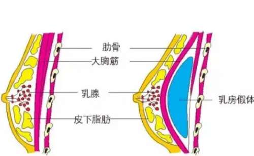 假体隆胸1.jpg