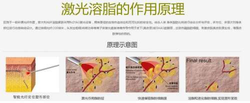 激光溶脂瘦脸.jpg