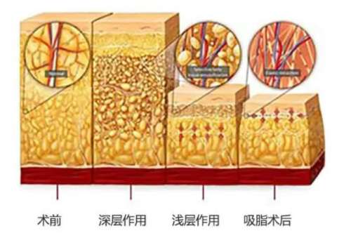激光溶脂瘦脸4.jpg