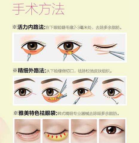 外切去眼袋.jpg