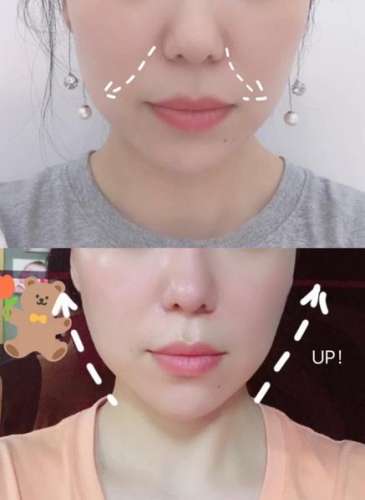 面部提升针.jpg