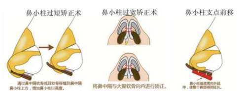 鼻小柱延长2.jpg