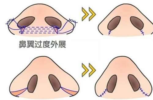 鼻翼 鼻翼
