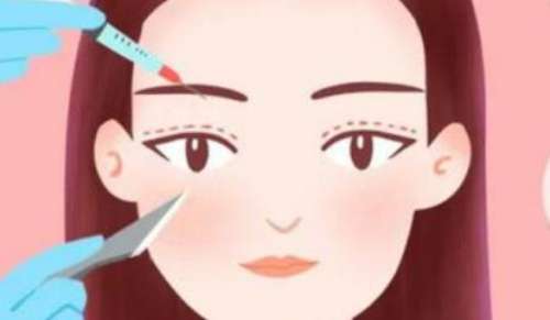 双眼皮19.jpg 双眼皮19.jpg