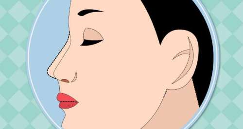 隆鼻10.jpg 隆鼻10.jpg