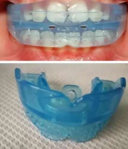 牙齿矫正器mrc和t4k.jpg