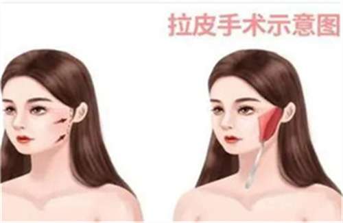 拉皮12.jpg