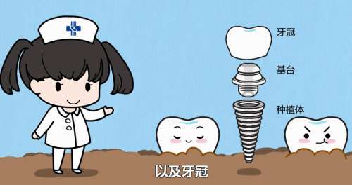 牙齿种植03.jpg