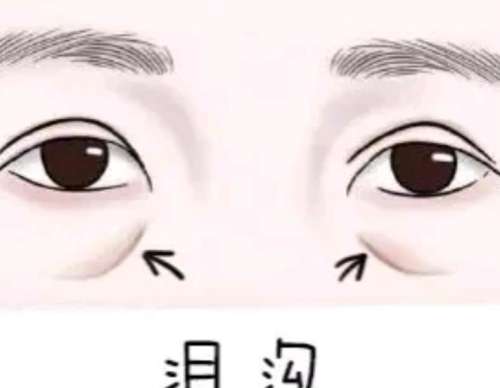 泪沟填充动漫03.jpg 泪沟填充动漫03.jpg