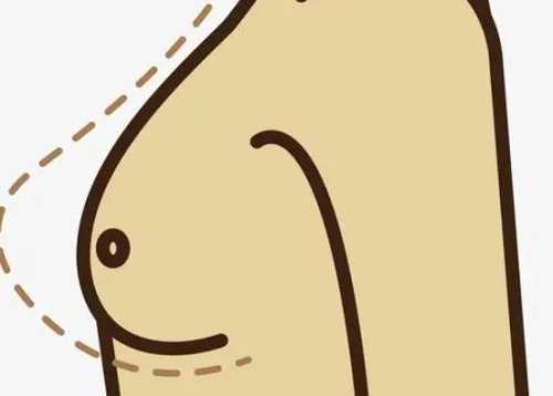 隆胸 隆胸