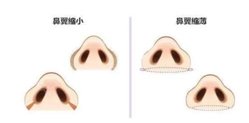 鼻头鼻翼缩小.jpg