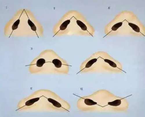 缩鼻翼2.jpg