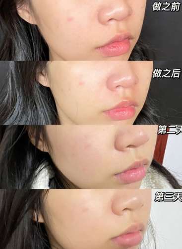 光子嫩肤2435.jpg