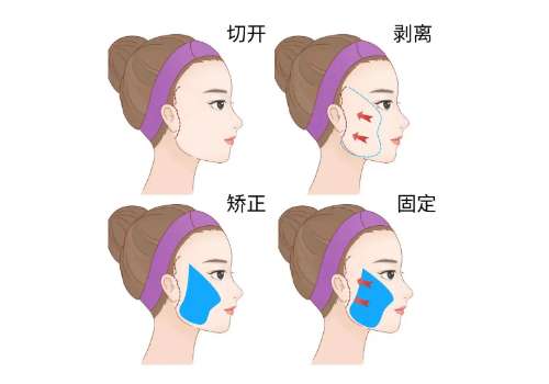 拉皮1.jpg