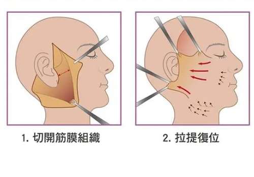 拉皮16.jpg