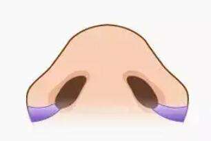 鼻翼缩小动漫03.jpg 鼻翼缩小动漫03.jpg