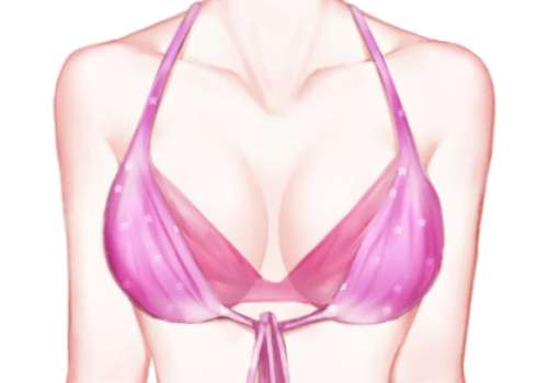 吸脂去副乳.jpg