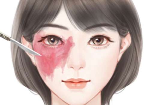 手术去胎记.jpg