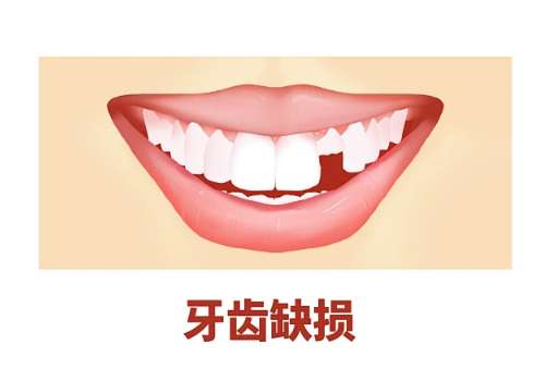 牙齿缺损.jpg
