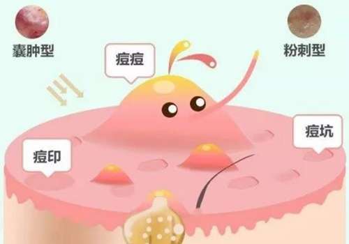痘痘 (4).jpg
