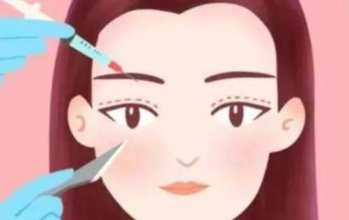 双眼皮 双眼皮