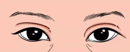 双眼皮 双眼皮