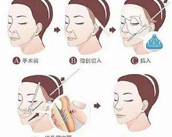 筋膜悬吊02.jpg 筋膜悬吊02.jpg