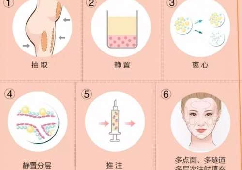 脂肪填充2.jpg