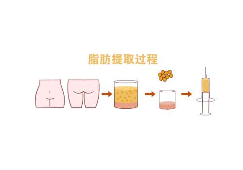 脂肪填充3.jpg