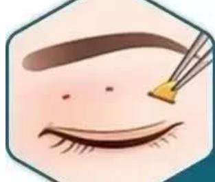 双眼皮 双眼皮