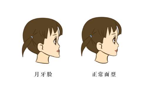 正颌.jpg