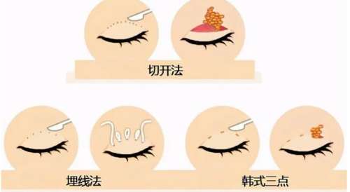 双眼皮 双眼皮