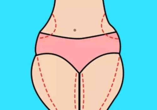 大腿吸脂hg7.jpg