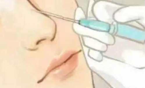 注射隆鼻 注射隆鼻