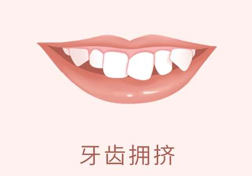 牙齿拥挤1.jpg