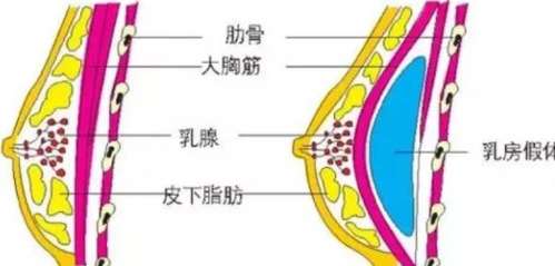 隆胸 隆胸
