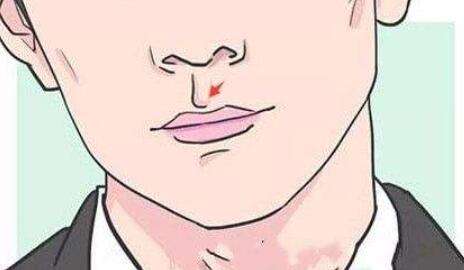 唇腭裂 唇腭裂