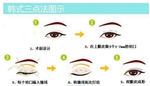 双眼皮 双眼皮