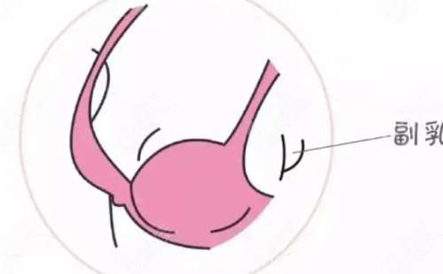 副乳02.jpg 副乳02.jpg