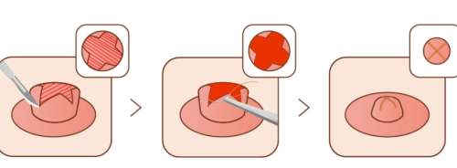 副乳01.jpg 副乳01.jpg