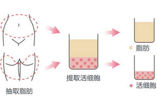 脂肪填充.jpg