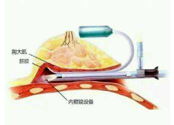 隆胸 隆胸