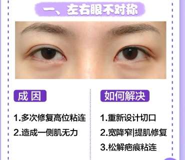 双眼皮 双眼皮