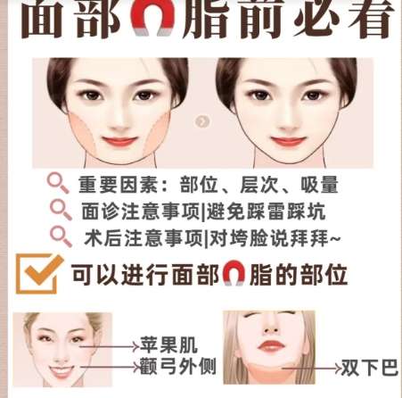 面部吸脂 面部吸脂