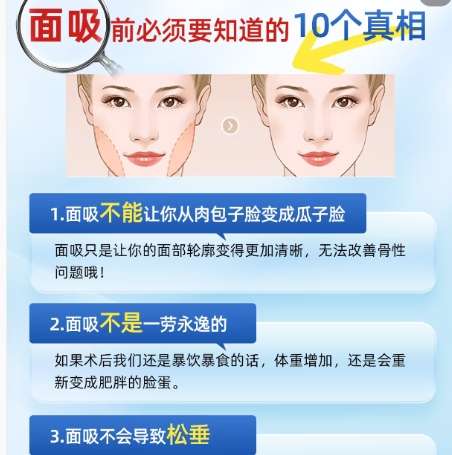 面部吸脂 面部吸脂