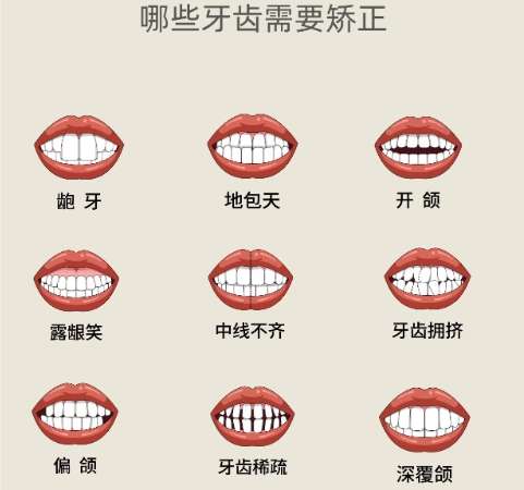 牙齿矫正 牙齿矫正