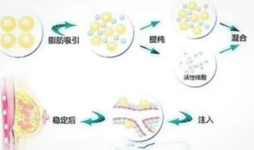 脂肪隆胸 脂肪隆胸
