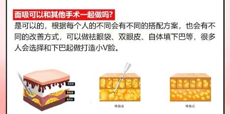 面吸 面吸